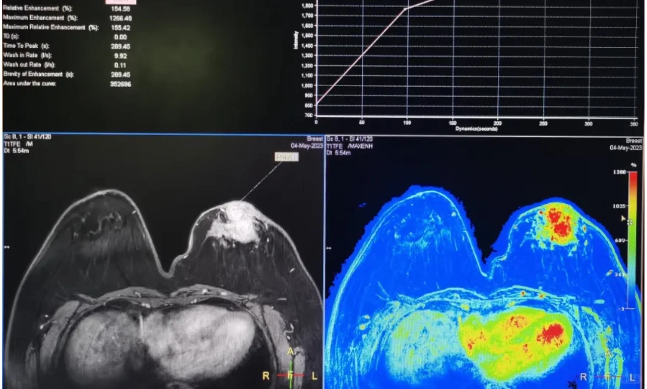 乳腺磁共振MRI平扫是不是没有用？