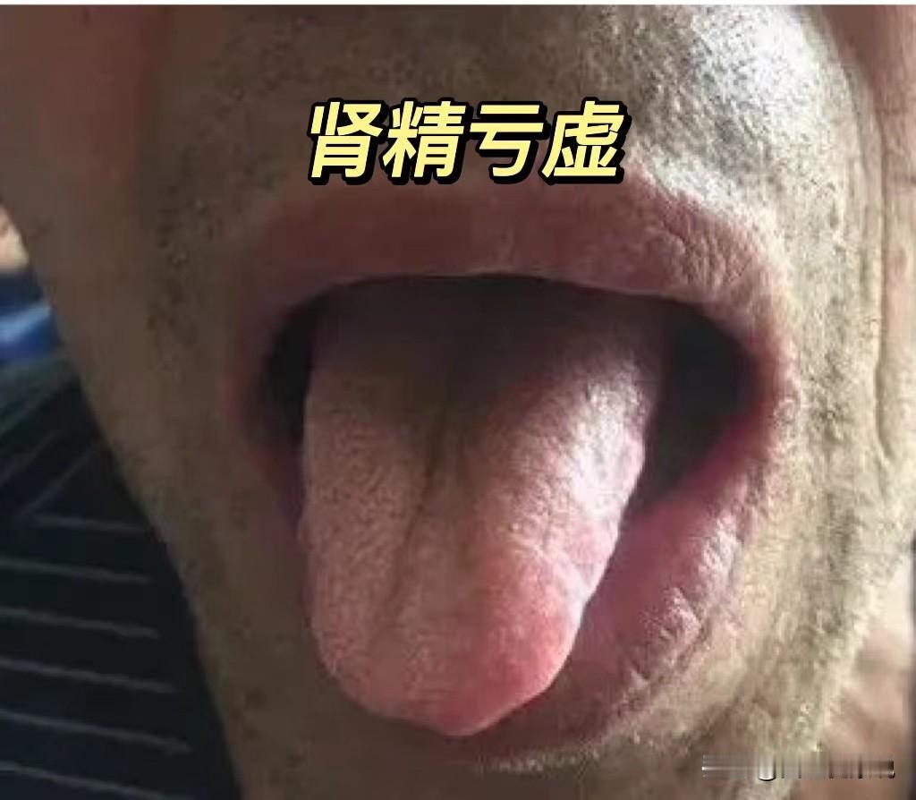 肾精足了，这个人就很有志气，有了一定的物质基础，精神层面才会好。
消耗肾精多的人