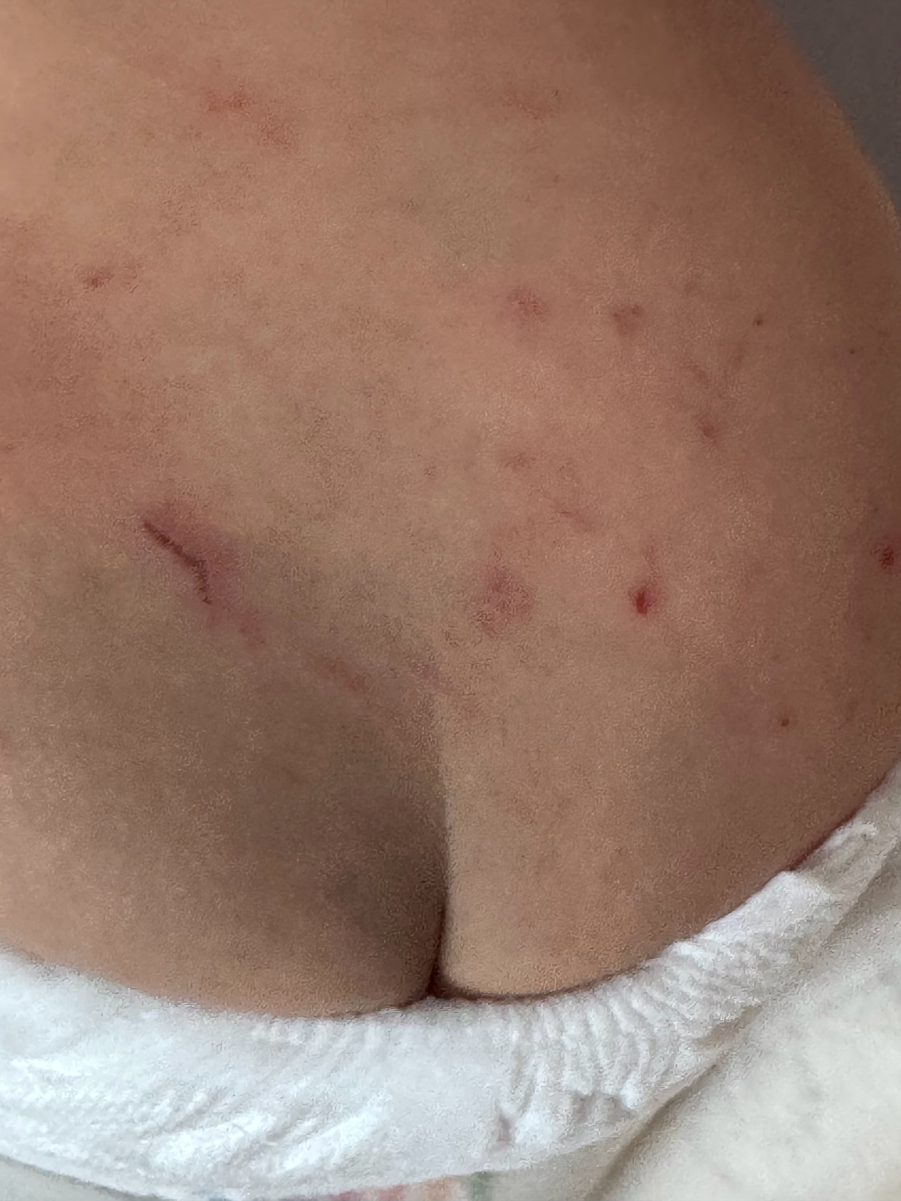 纸尿裤 有毒这个症状是不是也不知道是热的 还是有毒…… 北京