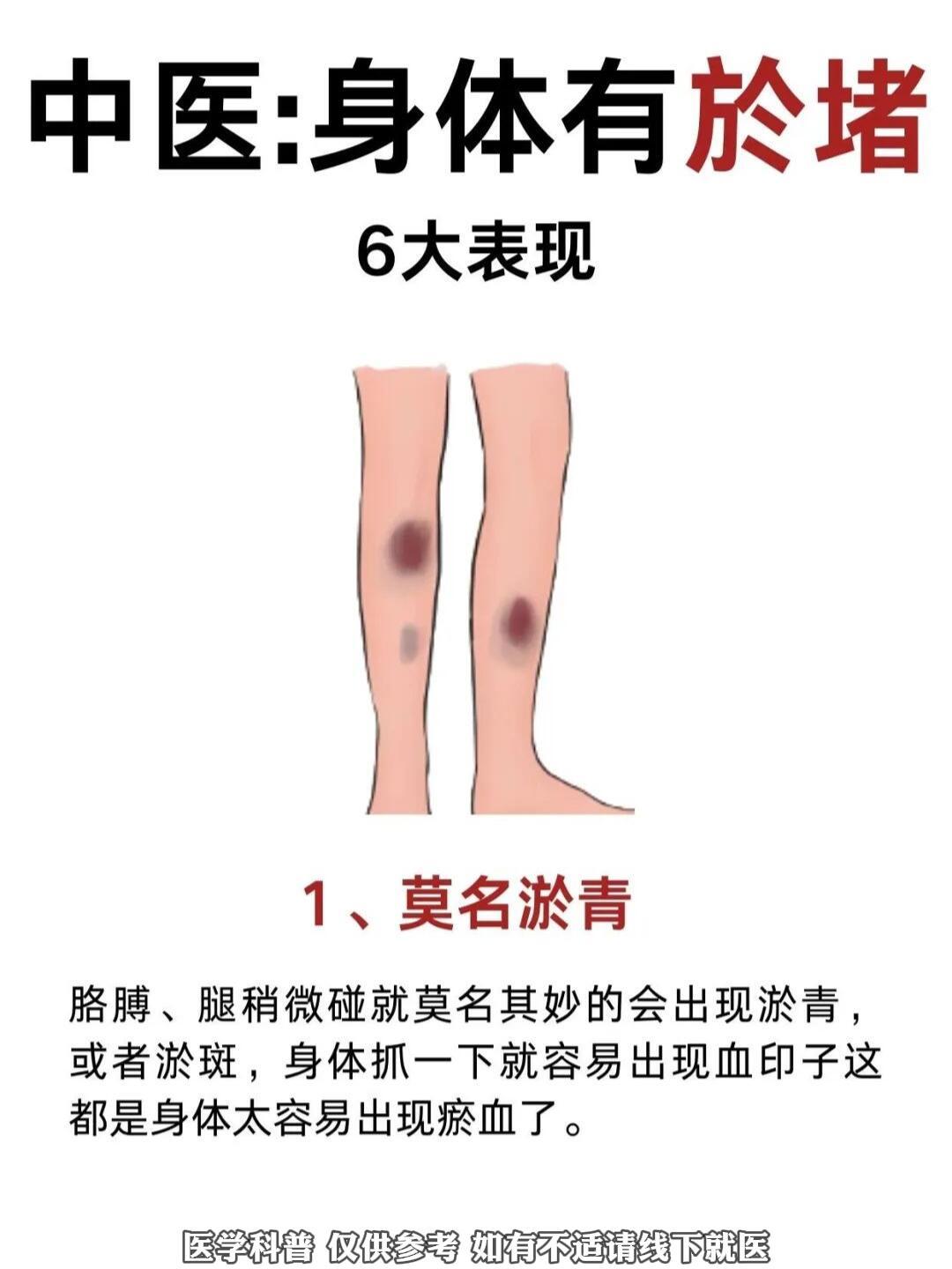 一起来看下你身体淤堵了没？国医的精诚力量