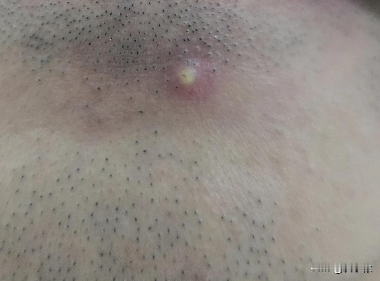 那些脸上长痘痘的年轻人们，你们总是抱怨自己脸上为什么长痘痘，或许你们可以从我这里