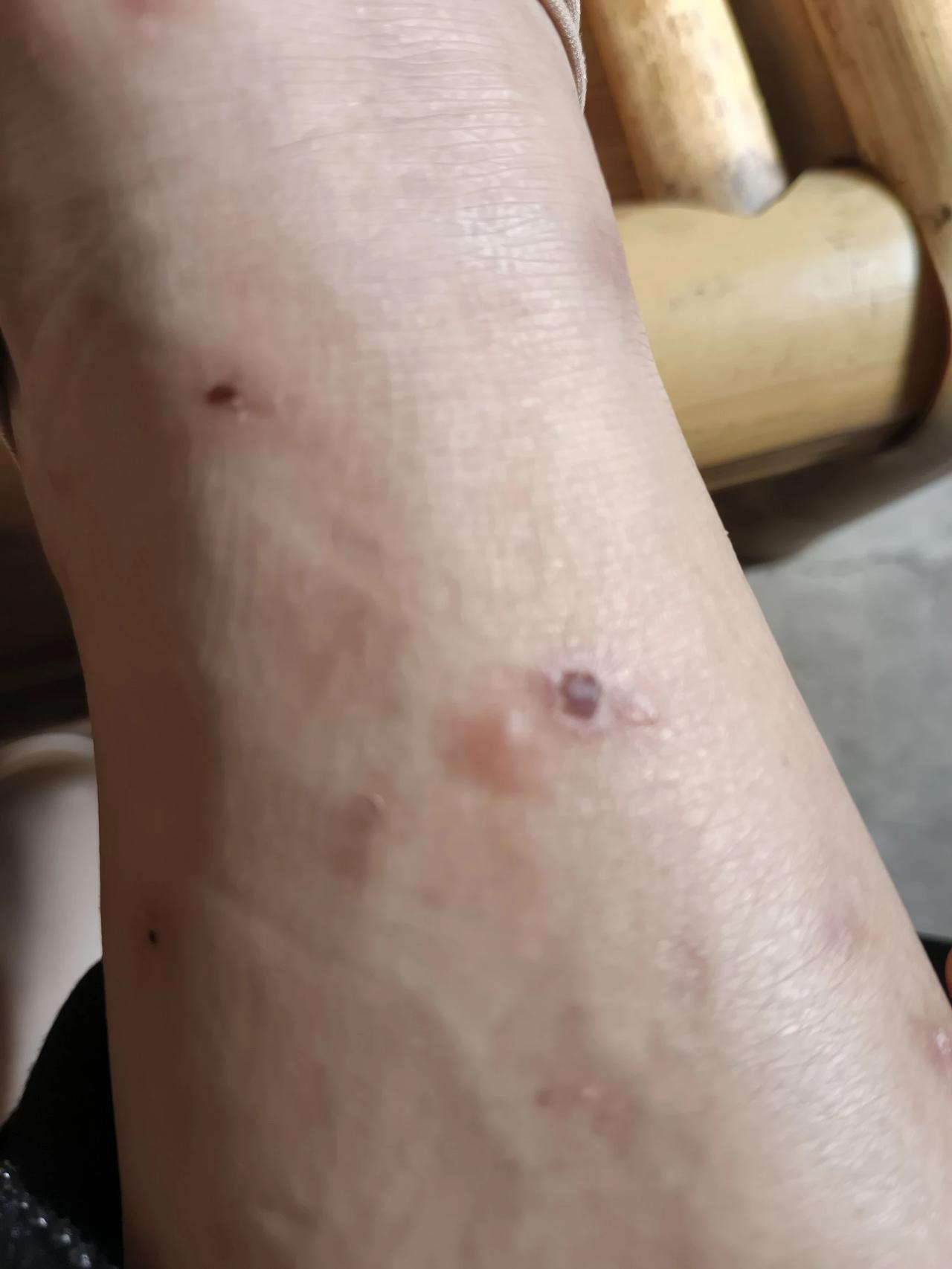 头条友友们早上好，我这些天真是愁死了，我身上出了很多的小疙瘩，脚脖更加厉害，奇痒