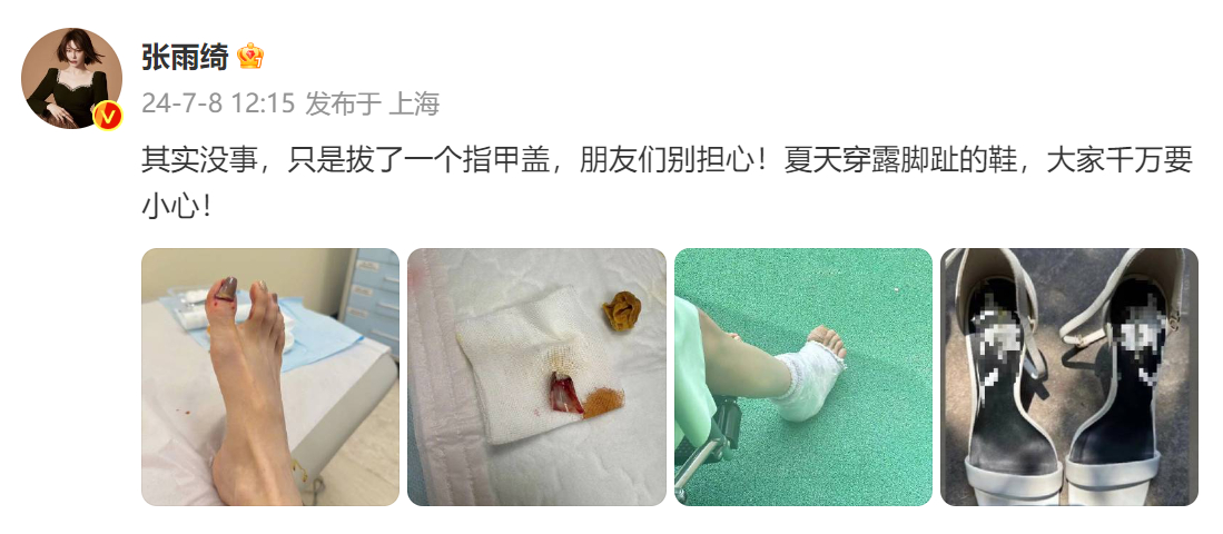 #张雨绮拔了一个脚指甲#  张雨绮脚受伤，拔了一个指甲盖...九敏，是看着都觉得