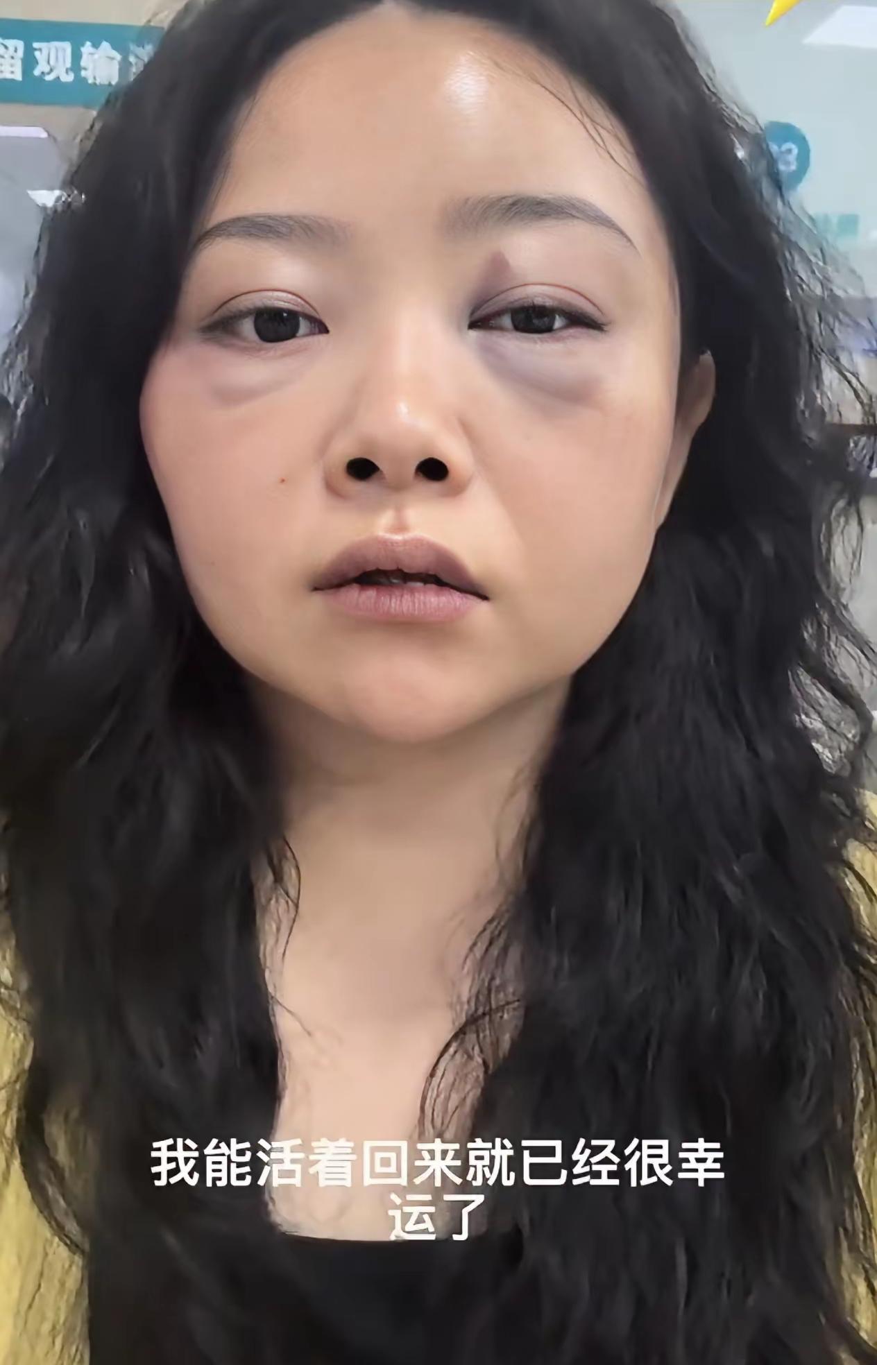 满心奔赴跨国爱情，却换来两眼淤青。女子发视频感慨：能活着回国，已经很幸运了！
 