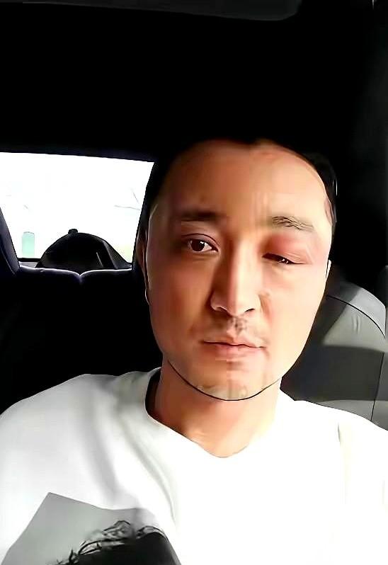 央视主持人尼格买提，这次是真的“破相”了。
他在社交平台上甩出一张照片，平时的帅