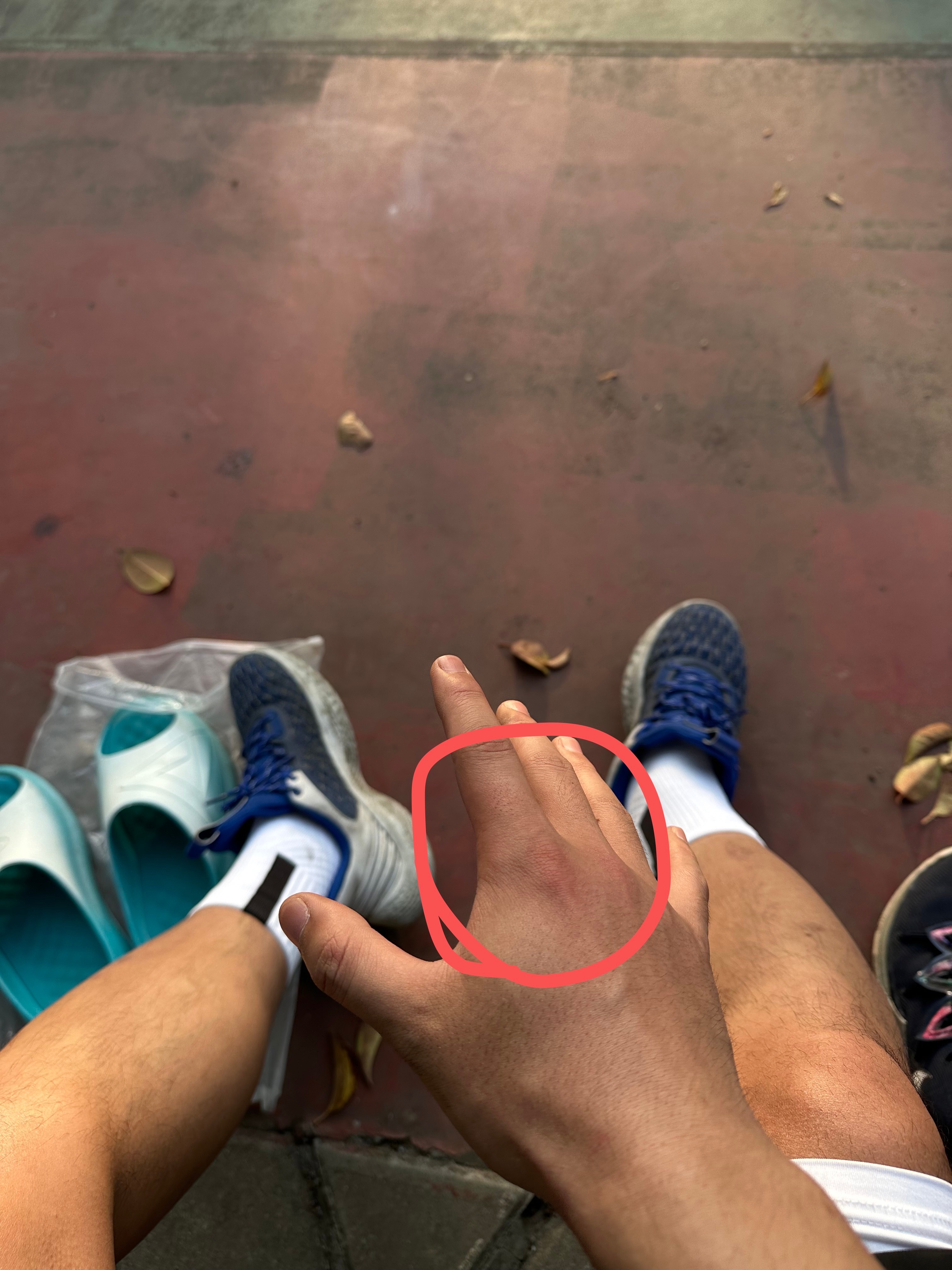 我才发现昨天打球手被人打肿了今天拿不动筷子