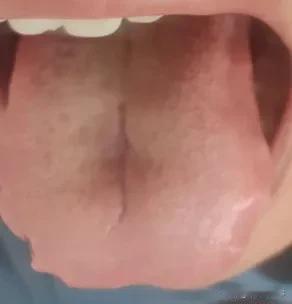 这种肾虚的病人，千万别一上来就金匮肾气丸、桂附地黄丸，不仅补不上去，说不定还上火