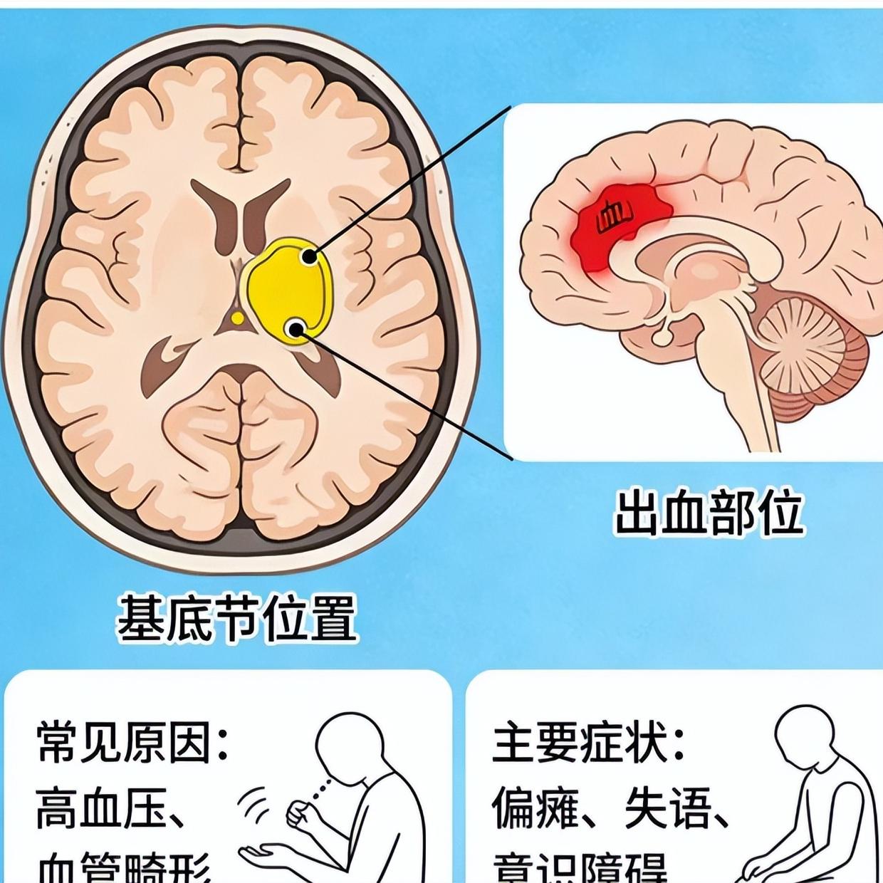 脑出血重灾区竟是基底节？3大后遗症太害人

基底节这地方不大，但位置很关键。一旦