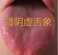 这种舌头是虚火，一定不要只顾着清热！
 
舌头嫩又红，还老爱上火，其实呀，这种情