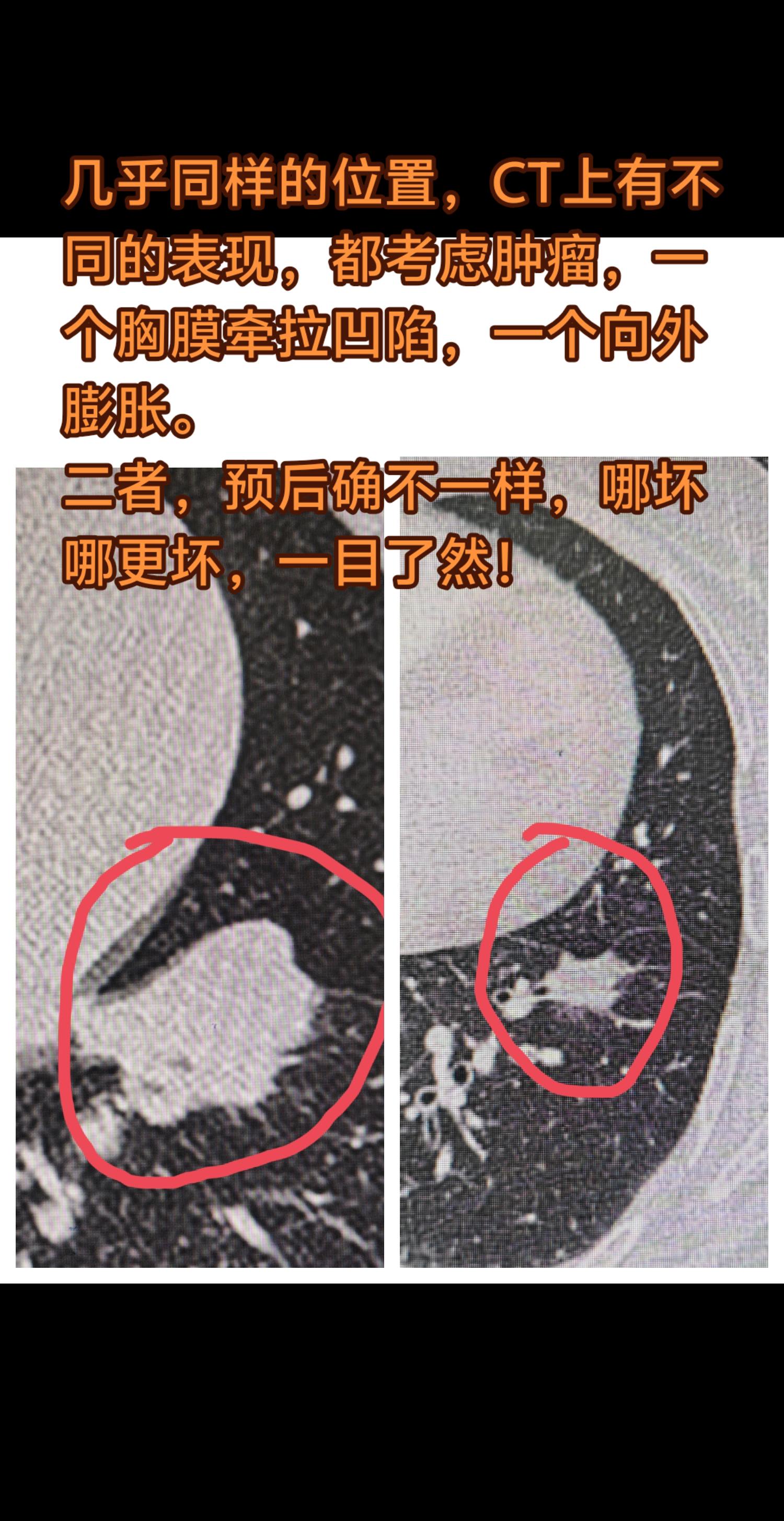 肺癌的不同表现。不同病人，几乎同样的位置，长了肿块，都考虑肿瘤，CT表...