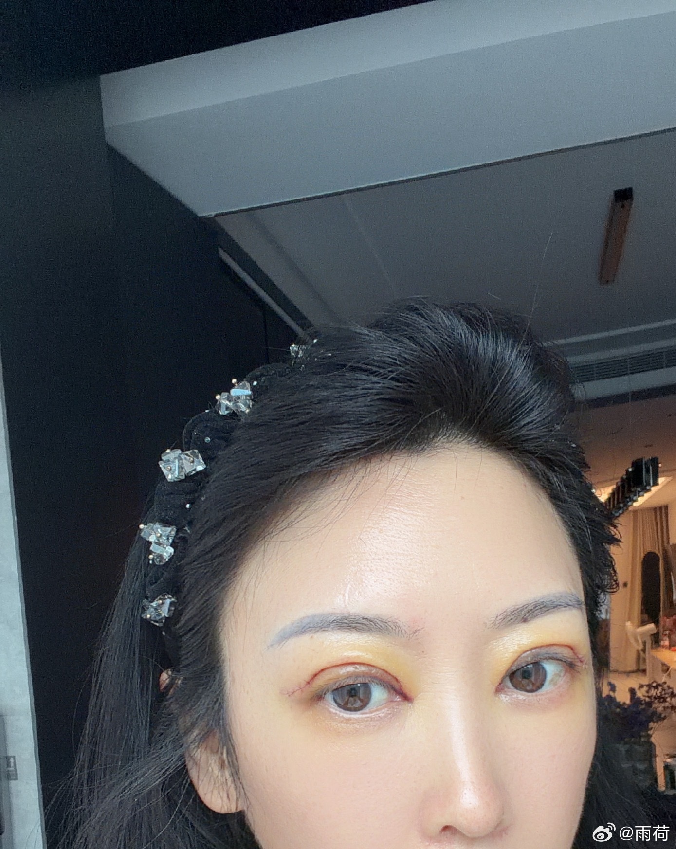 双眼皮修复第三天，不知道这次能不能上岸目前看比上一次强。双眼皮双眼皮修复 郑州