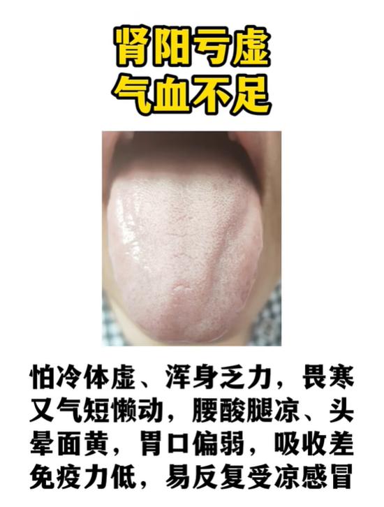 三类舌诊辨证：肾阳亏虚、气滞血瘀、肾气不足