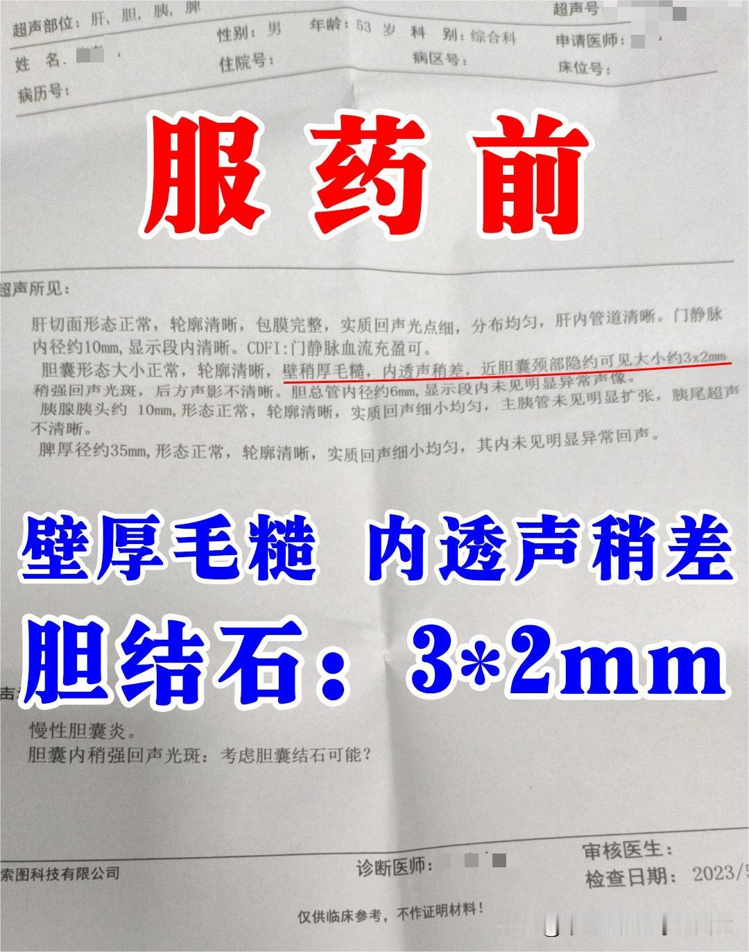 这个患者就是很常见的一类，因为胃脘部疼痛，右上腹时有胀闷，去医院检查，显示胆囊壁