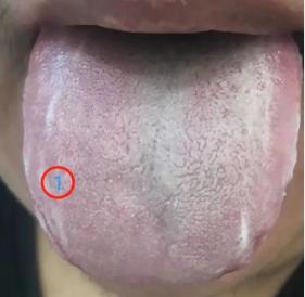 教你看舌象，分清寒湿和湿热！

 
先看第一张图：寒湿的舌头
 
患者情况：畏寒