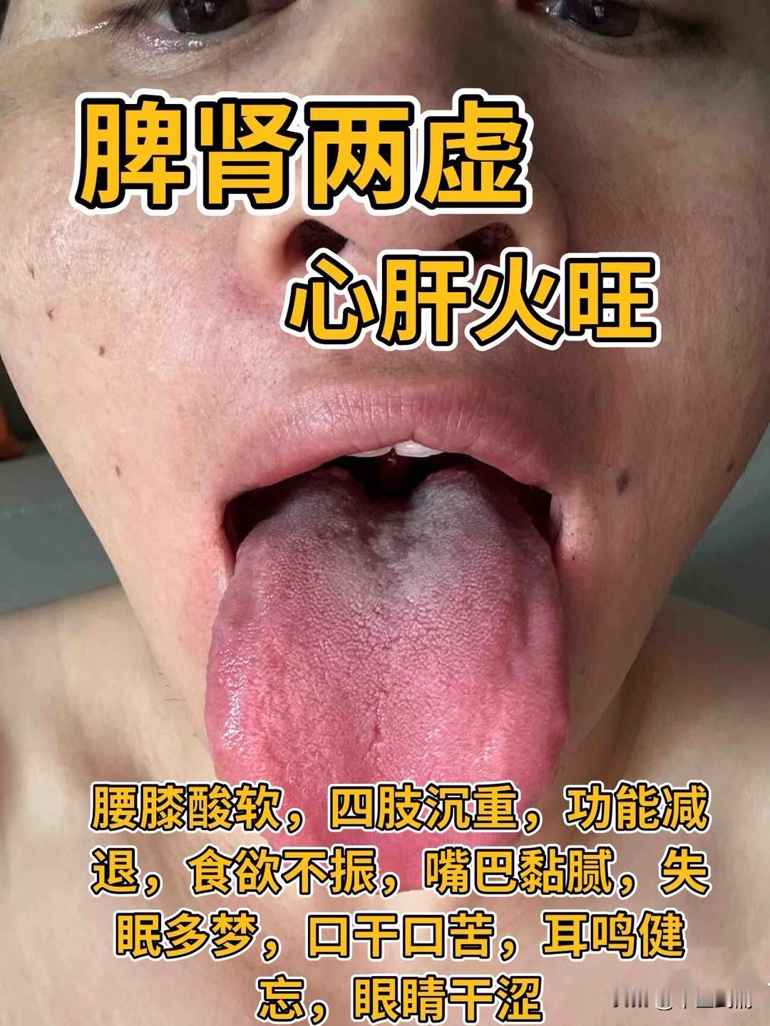 舌诊分享：
以下患者都是今天早上找到武医生辨症！
1. 脾肾两虚  心肝火旺 2