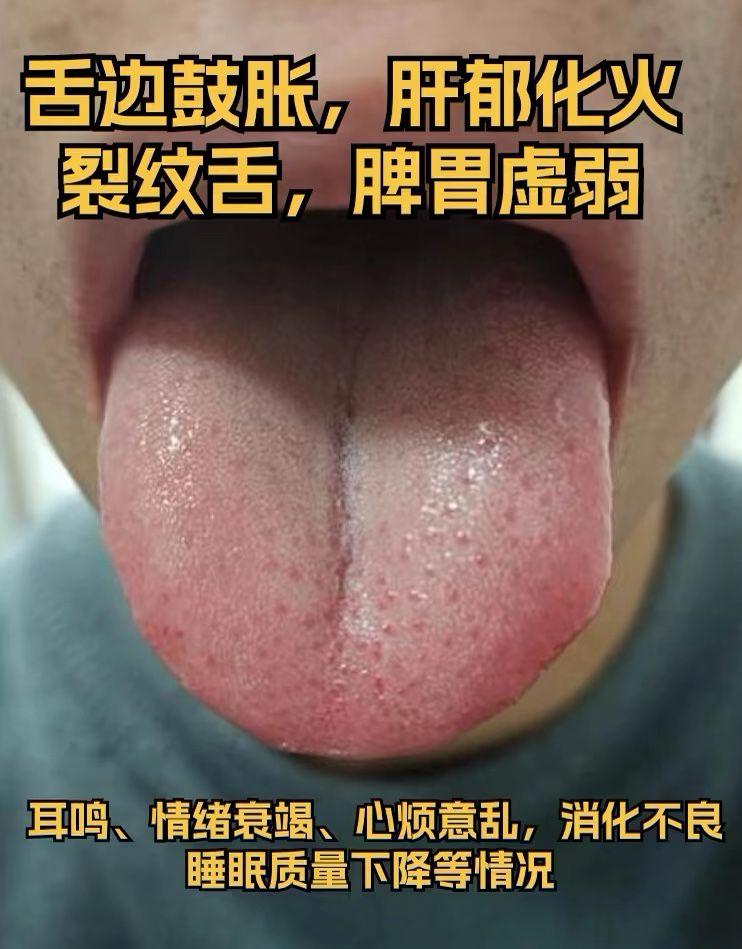 脾胃虚弱的粉丝 看看这三种舌象 对比你的