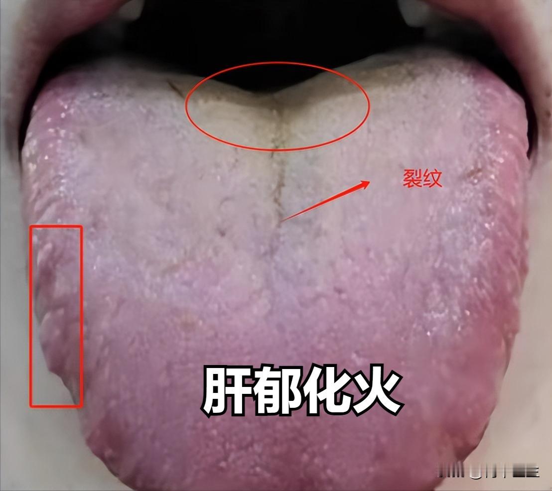 今日舌诊总结：
（一）湿热下注，肝郁化火
症状：舌苔发黄，舌质红，舌头两侧鼓胀，