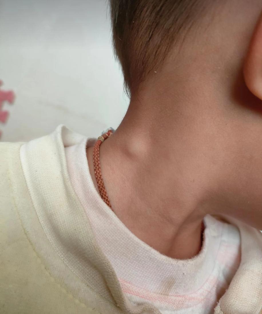 宝宝脖子上莫名长了一颗东西，摸起来滑滑的，用手按压还能来回移动，明显感觉比之前长