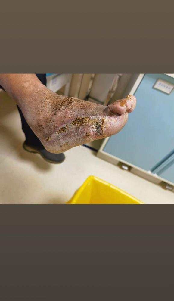 同志们 一定要控制血糖！

我家老头得二型糖尿病三年多，之前跟个倔驴似的，说多了