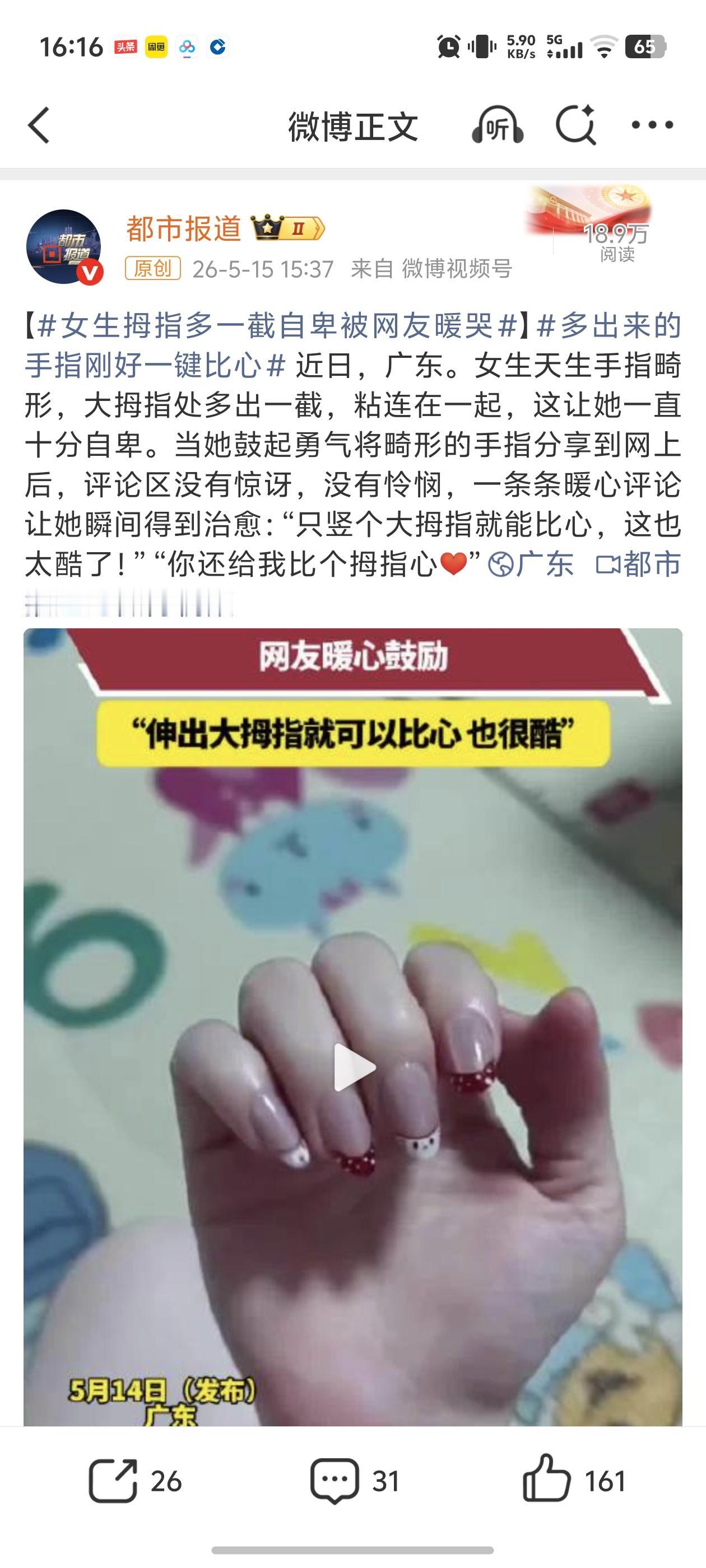 看着特别暖心！女孩天生手指发育畸形，大拇指多长出一截还粘连在一起，从小到大没少被