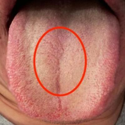 男人最怕这种裂纹舌！一补就上火，2个便宜小方，裂纹自消！

年后复工，很多男同志