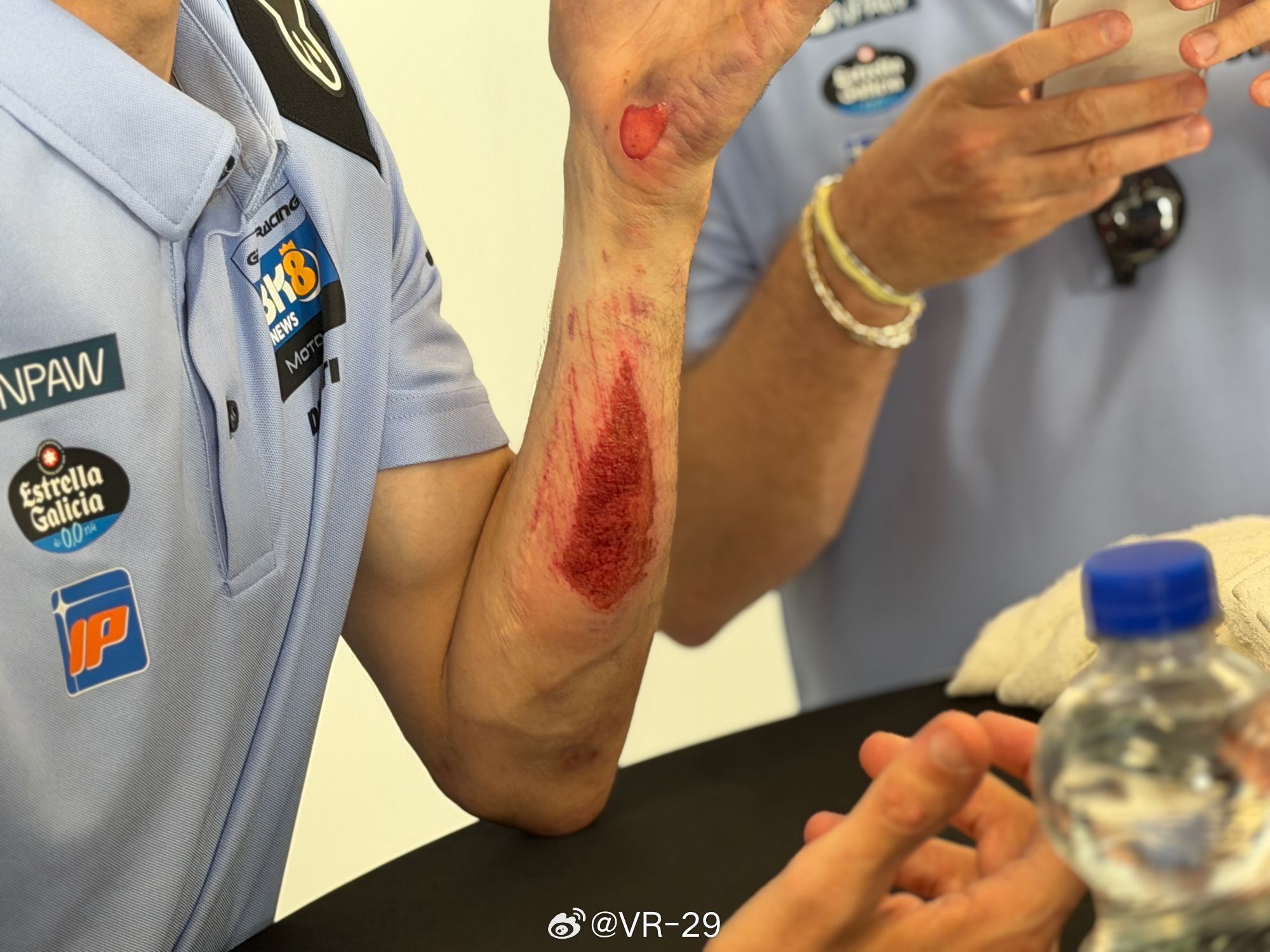Alex Márquez摔车后的擦伤motogp