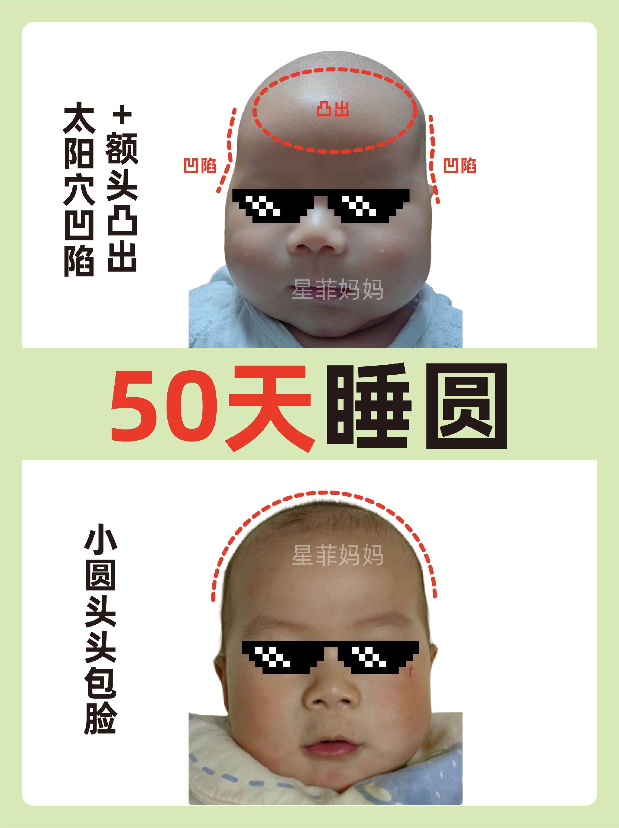 真实案例太阳穴凹陷额头凸出如何睡圆头。