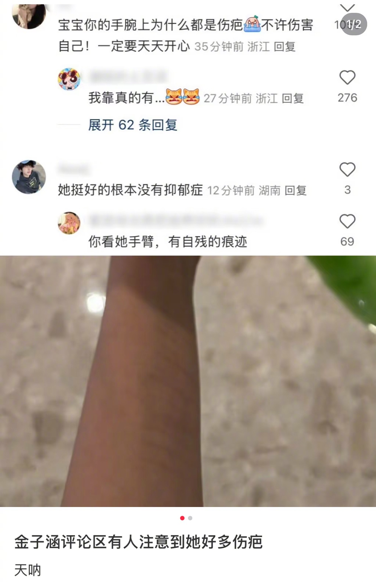 金子涵手臂疑似有自残痕迹……这是伤疤吗？ ​​​