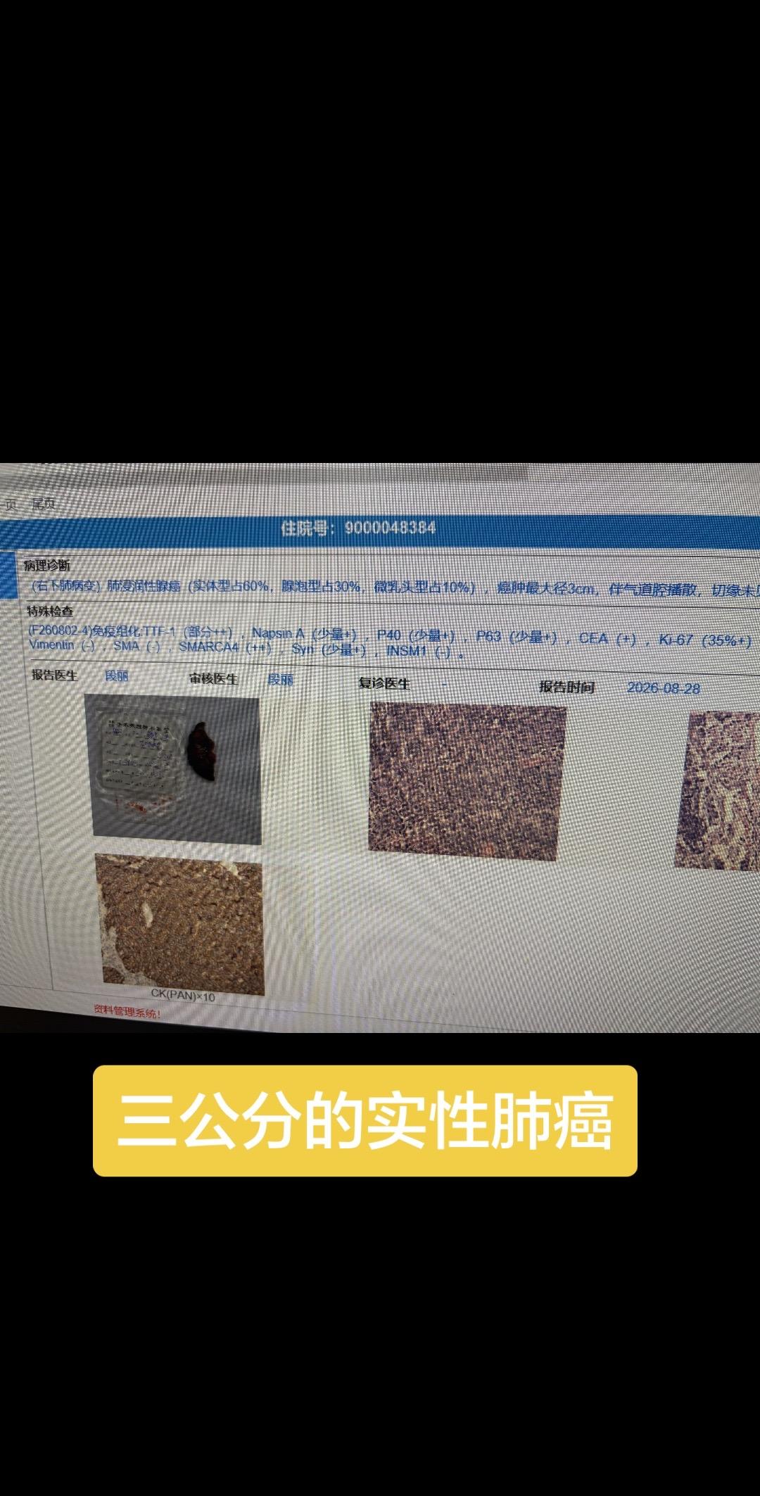 三公分的实性肺癌，系统性的清扫淋巴结，第7.8组淋巴结阳性，N2阳性...