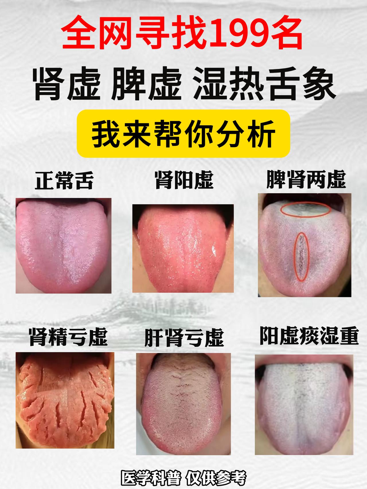 全网寻找199名，肾虚、脾虚、湿热舌象！我来帮你分析，忙完回复