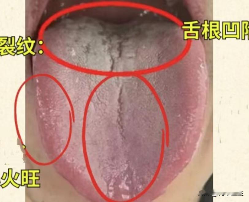 宗筋疲软，功能下降，这种舌头你去吃金匮只会上火，肾是补不了一点，听我一句劝，先清