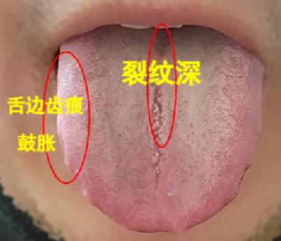这种舌象，是脾肾两虚+肝郁化火，热邪入筋，当然难以入门！
 
患者症状：
1、起