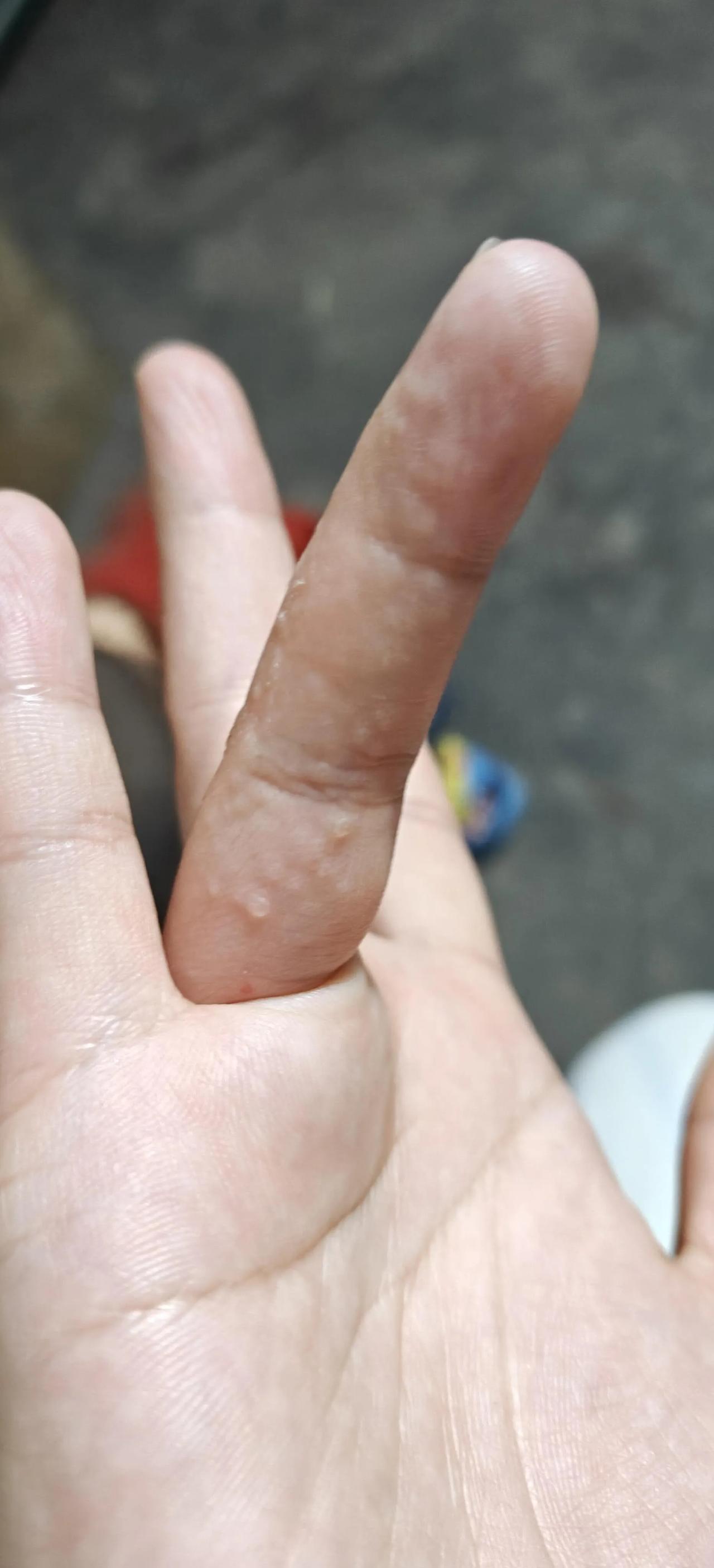手上长像小水泡一样的很痒不知道怎么搞的，最近长这么多小水泡，好痒啊，每当晚上睡觉