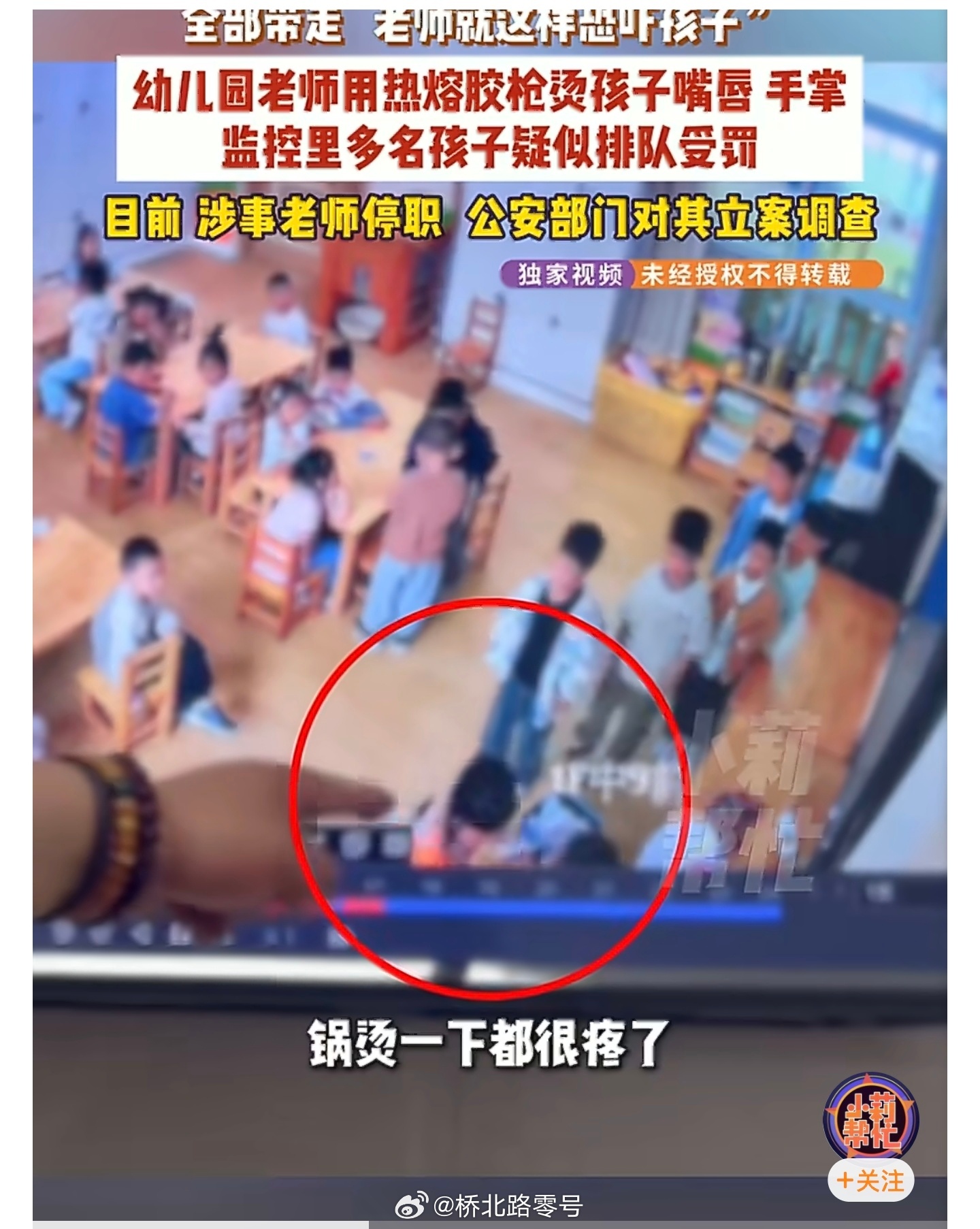 【幼儿园老师疑威胁剪掉幼童舌头】幼儿园儿童被老师用热熔胶烫到感染5月30日（发布
