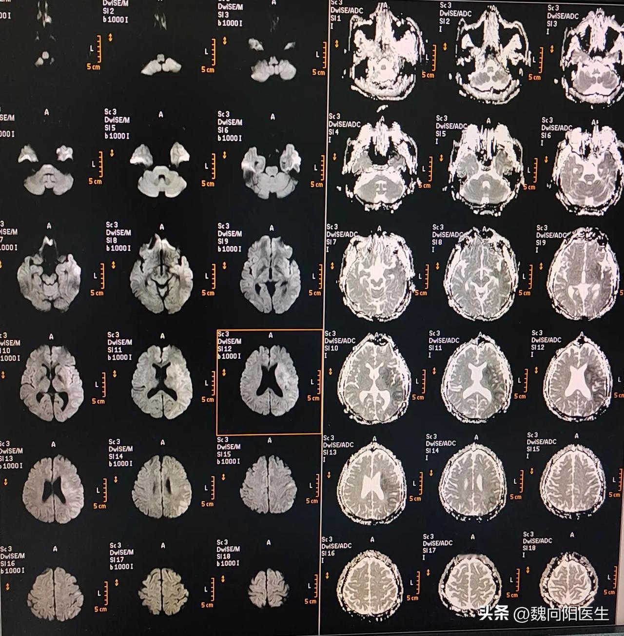 认识了将近10年的朋友，
突发意识不清伴右侧肢体活动不力，
嗜睡状态。
他第一时