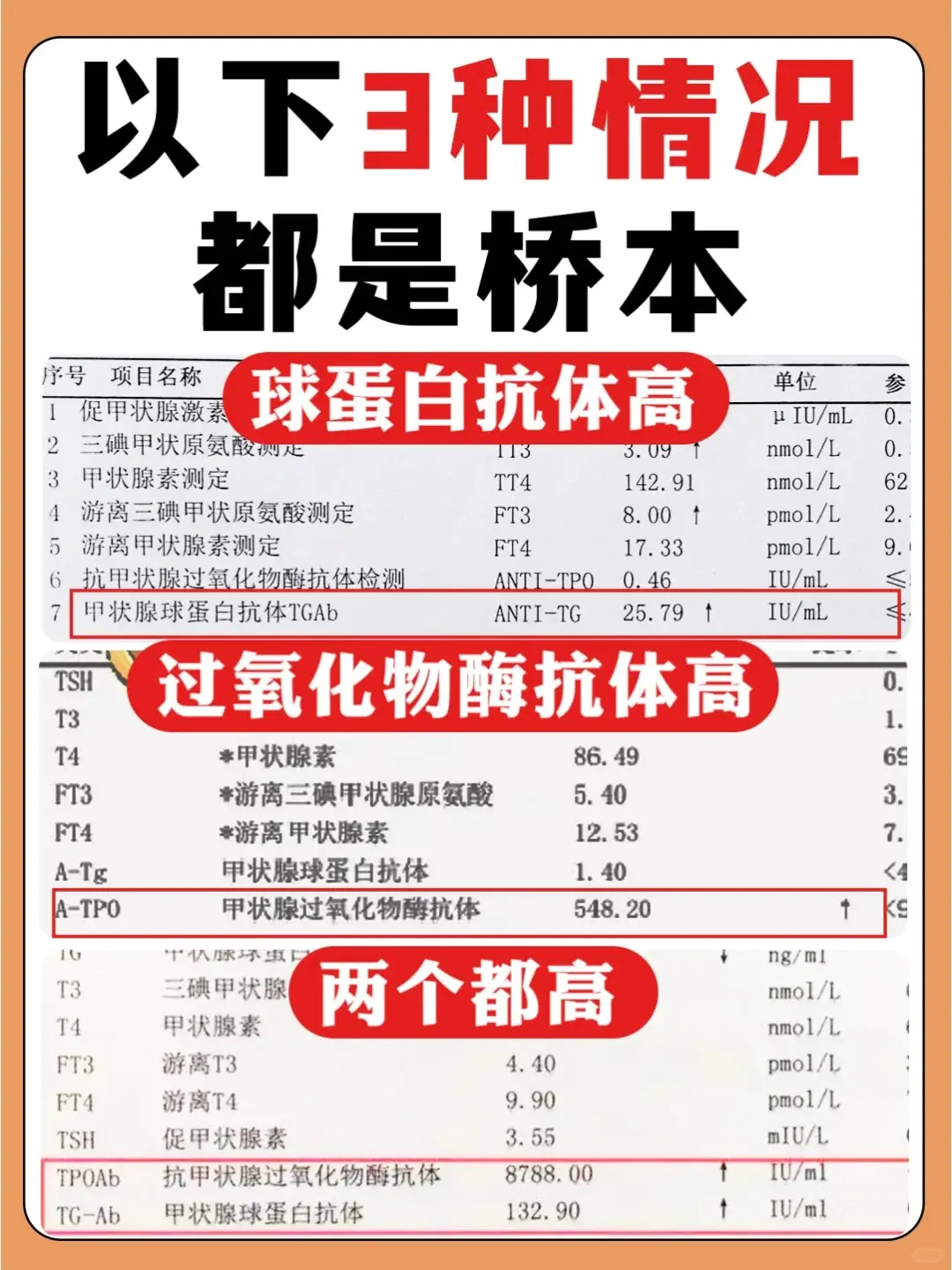 想知道自己是否中了桥本的“招”？只需要关注这两个抗体！ 甲状腺球蛋白抗...