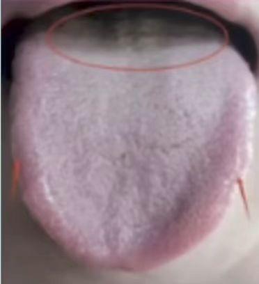 五毒全能舌，肝郁、脾虚、肾虚，上热下寒全占满了。
 
患者主诉，平时爱上火，出汗