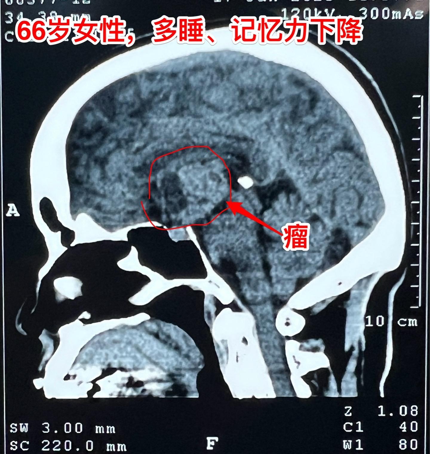 是颅咽管瘤吗？鞍区肿瘤的定性诊断是很难的。66岁女性，泰州人。因为多睡...