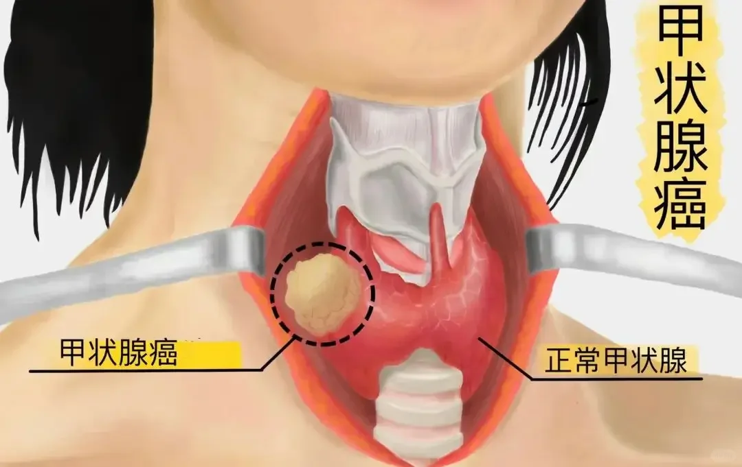 恶性程度高的甲状腺癌一定是晚期肿瘤？