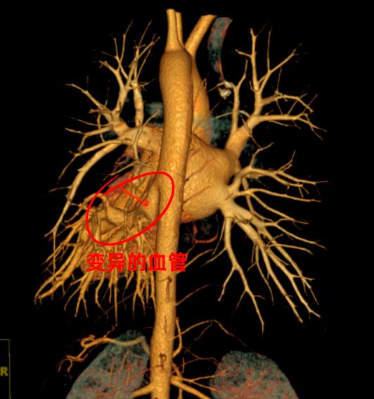 湖南，一名19岁小伙在家咳血去医院检查，拍完片觉得没事就回家了，不料医生审片时，