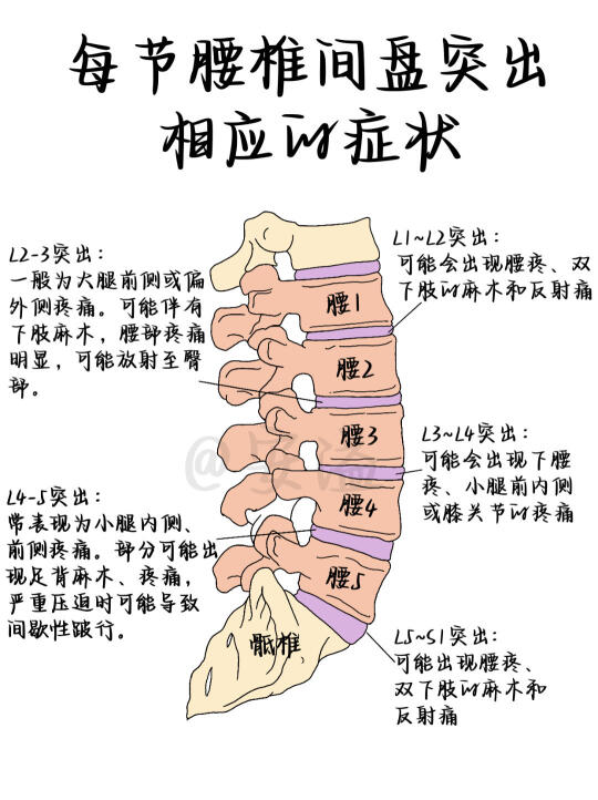 医学生绘本‖每节腰椎间盘突出对应的症状