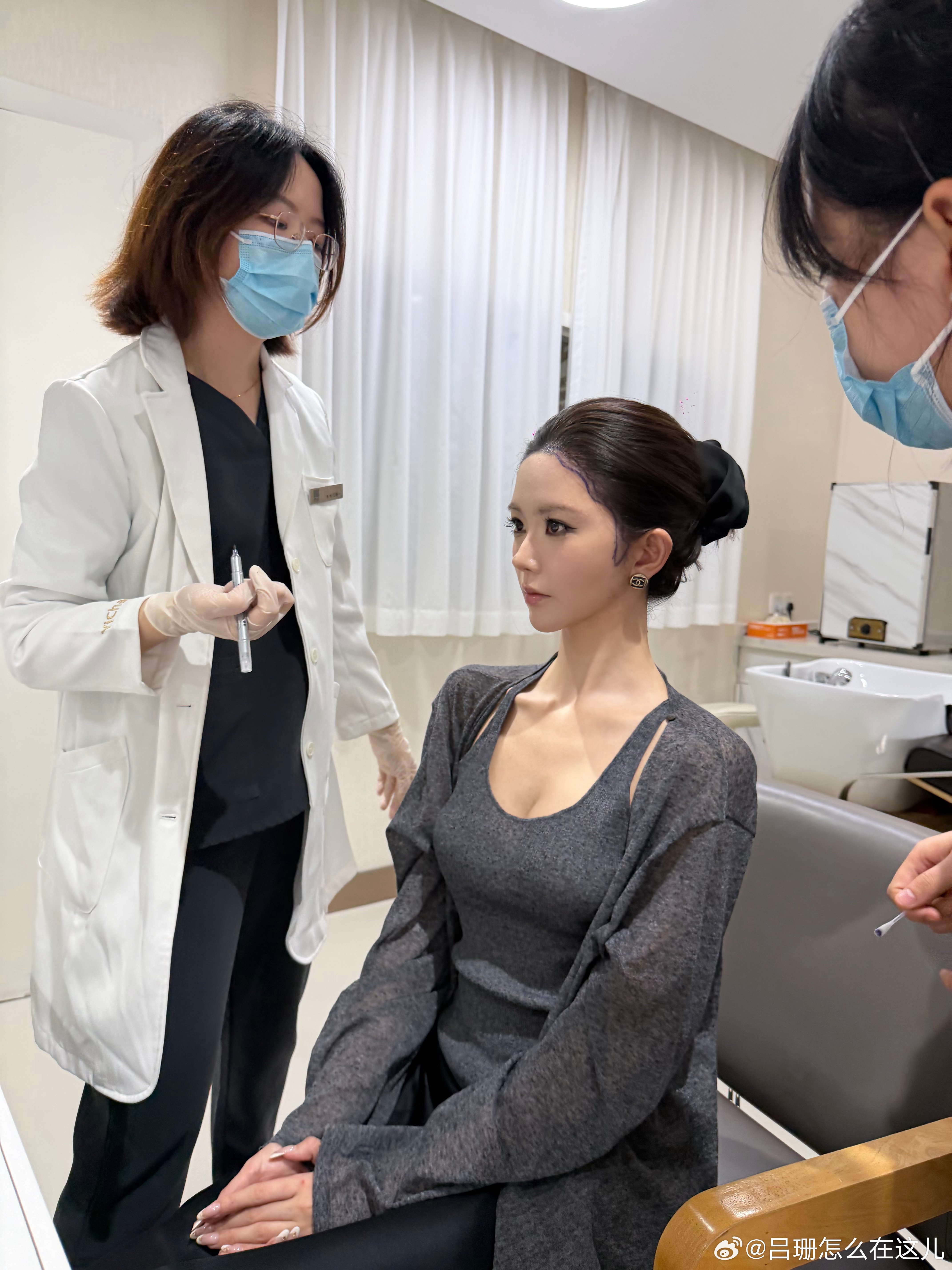 执行力满分的女人  又植发了 调整了发际线形状 加宽了鬓角 现在做完还在肿 但已