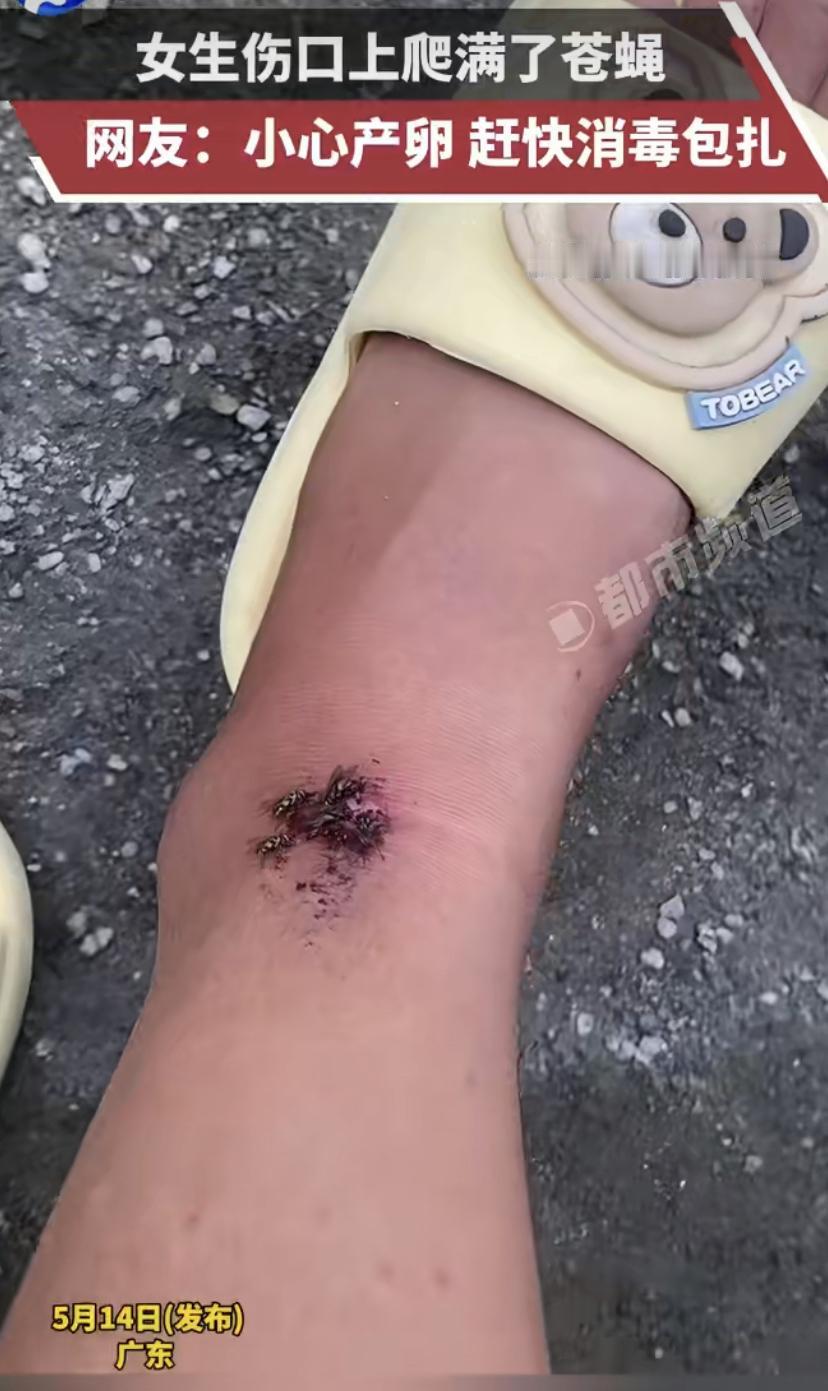 太吓人了!广东一女子脚不小心划了个口子，流了点血，想着小伤就没管。结果没过多久，