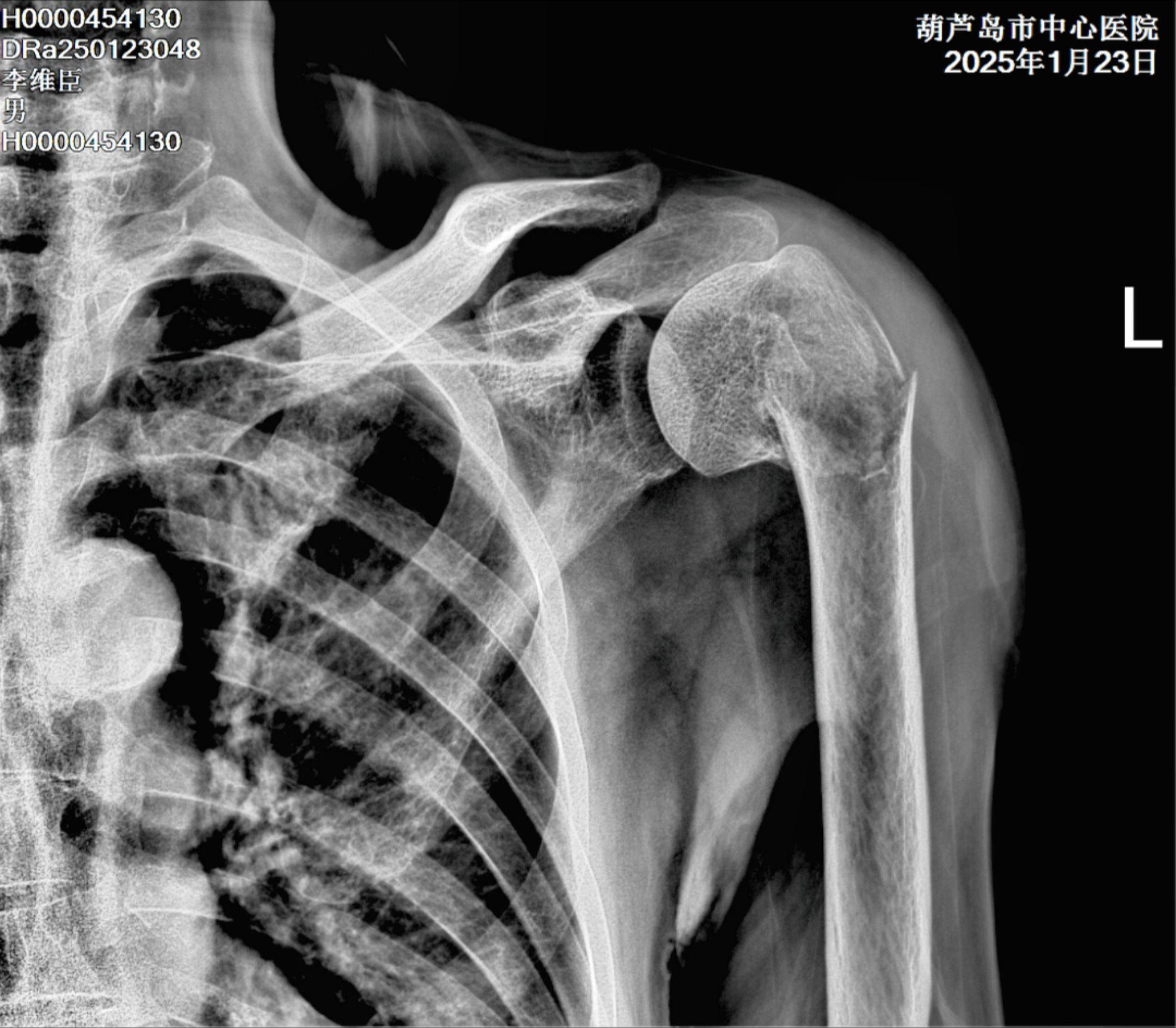 两部分内翻型肱骨近端骨折绝对是髓内钉的最佳适应症，微创、牢固，让生物学...