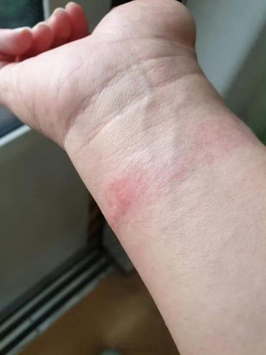 第一批戴运动手环的受害者出现了长期佩戴智能手环手表后，手腕皮肤发红发白粗糙，大家