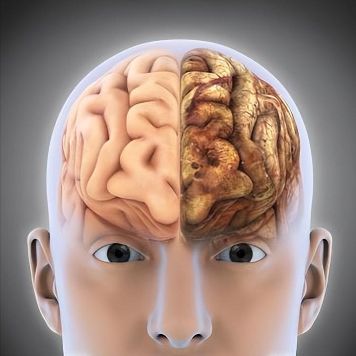 脑梗抢救成功≠脱险！四大隐藏杀手要知道
 
1. 脑水肿
脑梗死后，患者受损的脑