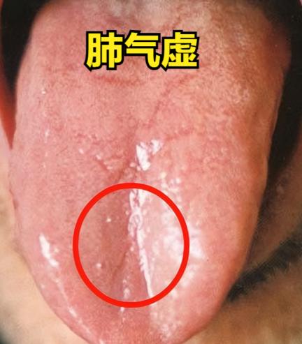 补气是提高免疫力最快的方法！中医教你分辨气虚，轻松提高免疫力！

1、肺气虚
表
