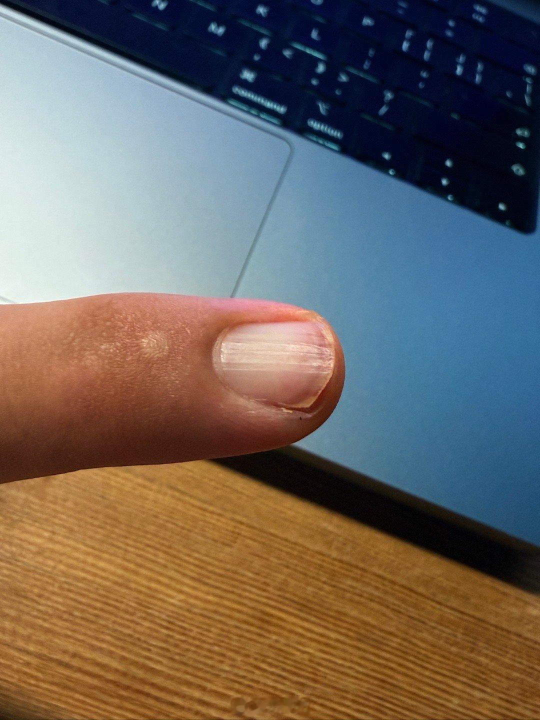 卧槽疼死我了！打蚊子，打到椅背上，指甲直接反向弯折了一下！瞬间血流不止，疼死我了