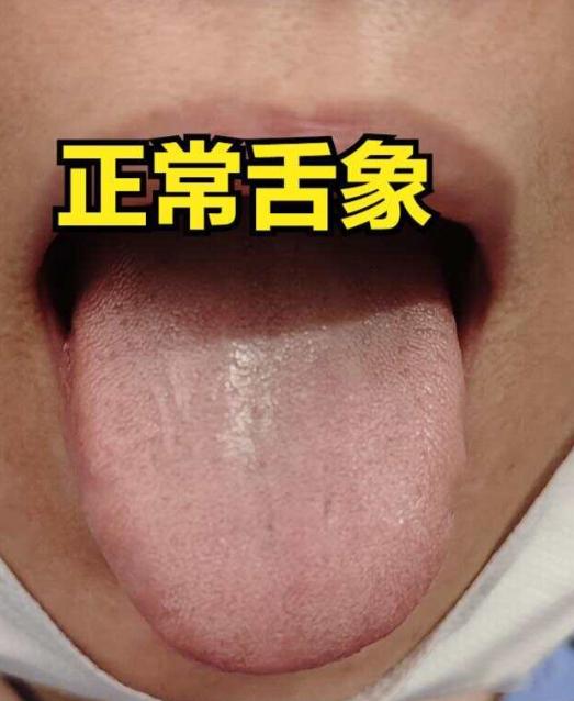从舌头气滞点，看肝郁变化的程度！一阶段对应一方！

1.气郁点——柴胡舒肝散加减