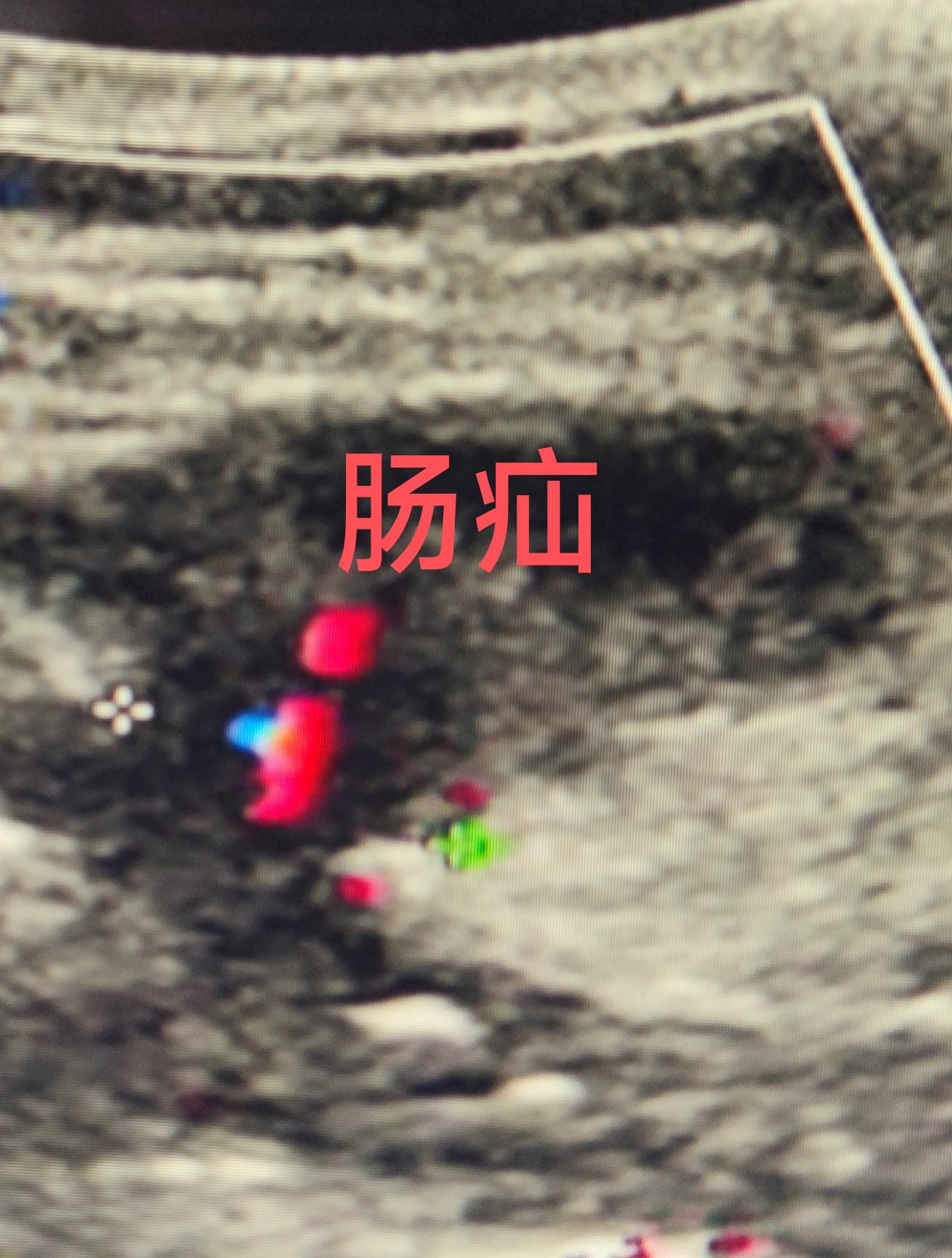 肠疝。只要有缝隙的地方
疝无处不在